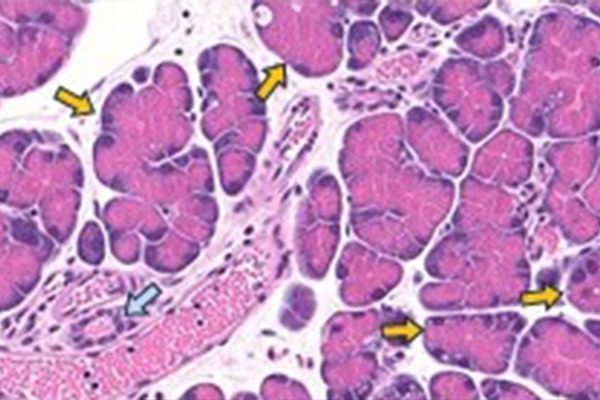 Blue arrows point to normal pancreatic ductal mouse cells. Yellow arrows point to cells undergoing acinar-to-ductal metaplasia. Credit: Johns Hopkins Medicine